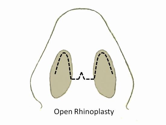 Open-Rhinoplasty.jpg (1192×900)
