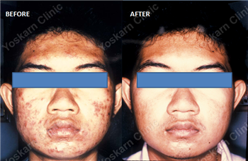acne treatment 1.png (796×519)
