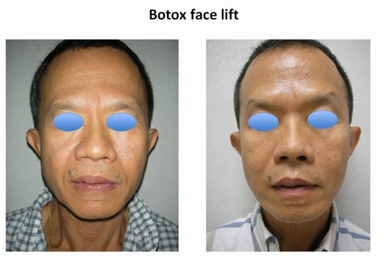 botoxface.jpg (900×613)
