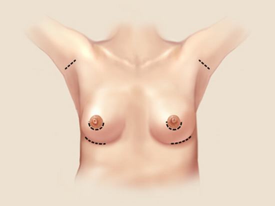 breast-enlargement-incisions-2col.jpg (388×291)