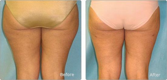 truth about cellulite