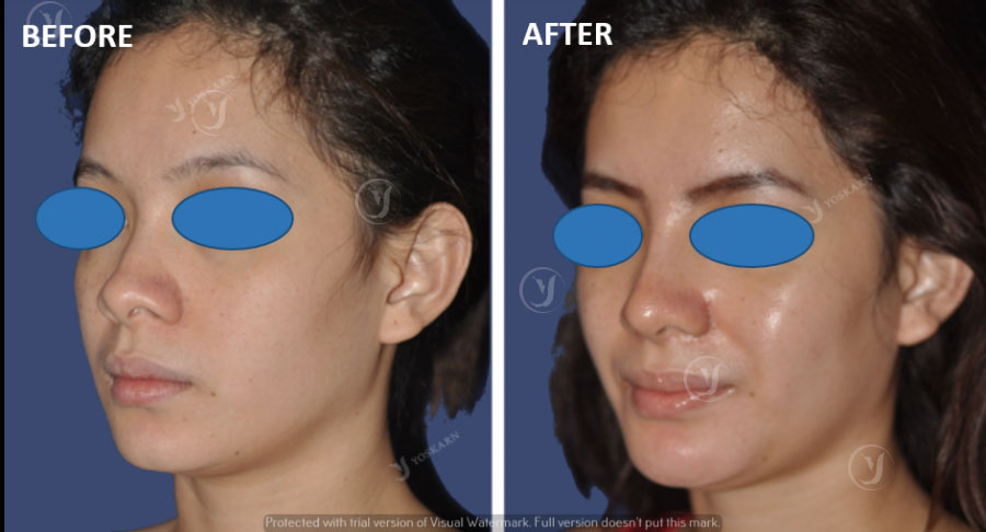 Short Scar Facelift in Thailand