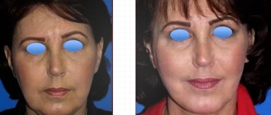 MACS Lift in Thailand