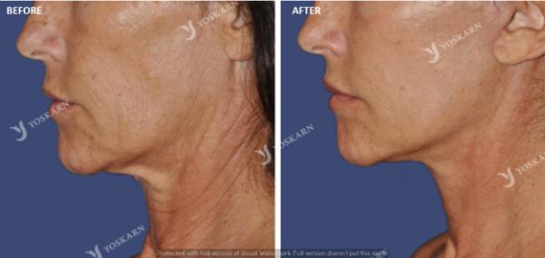 Mini Lift in Thailand