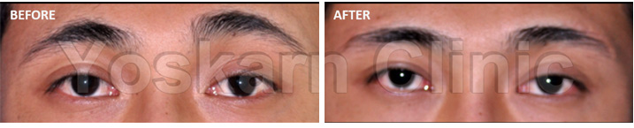 Brow Lift