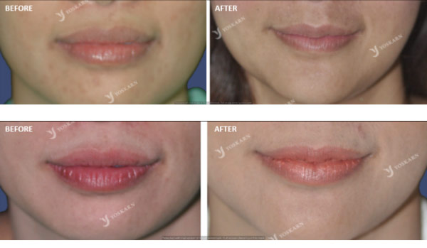 Lips-Contouring-Surgery