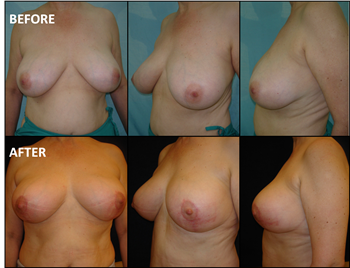 Breast Reduction