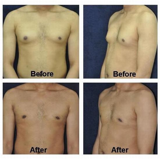 Male Breast Reduction