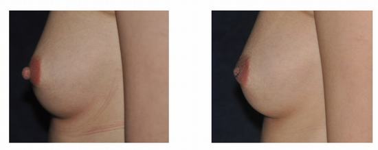 Nipple & Areola Reduction