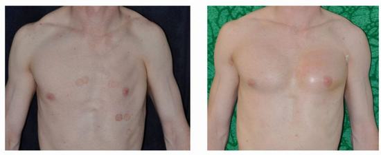 Pectoral Implant Surgery