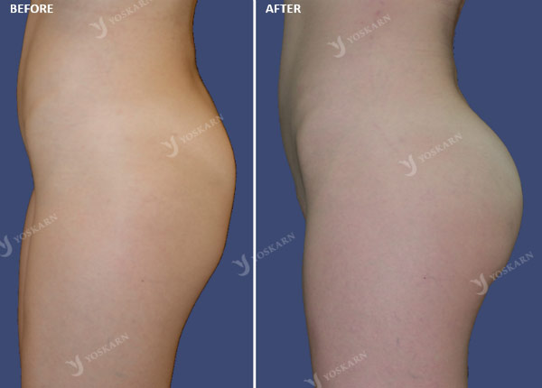 buttock augmentation