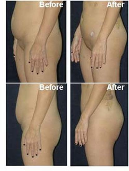 Body lift surgery