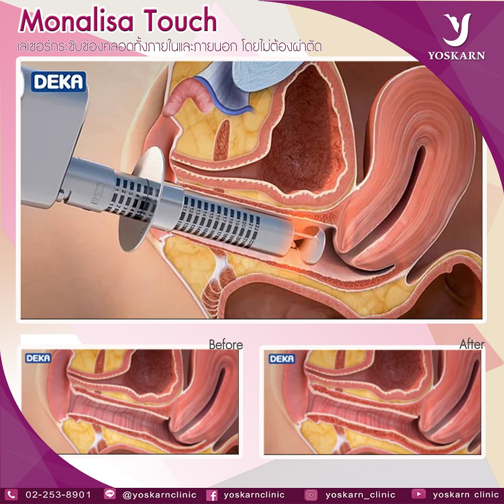 Laser Vaginal Tightening