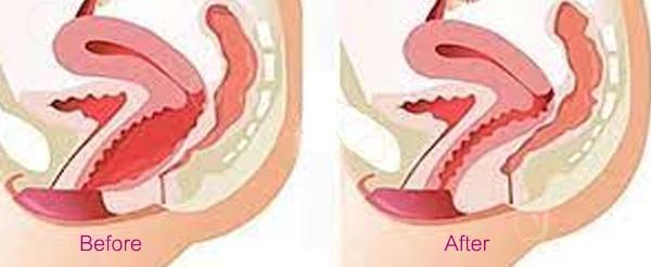 ThermiVa vaginal rejuvenation