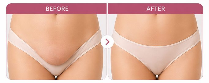 Mons Pubis Lift Surgery