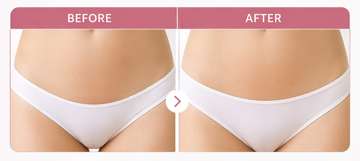 Pubic Area Liposuction