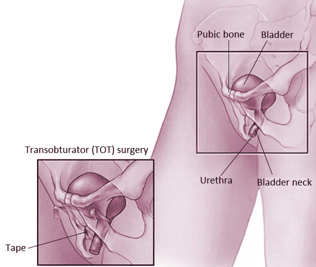 Incontinence Surgery