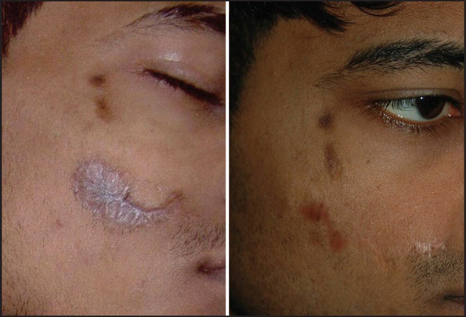 Advanced Scar Revision Treatments