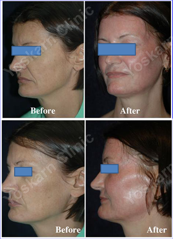 Newborn Skin Laser Treatment