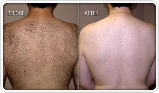 Laser Hair Removal