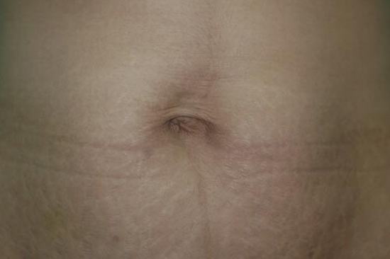 Stretch Marks Treatment