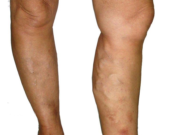 Varicose Veins Therapy