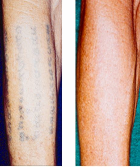 Tattoo Removal