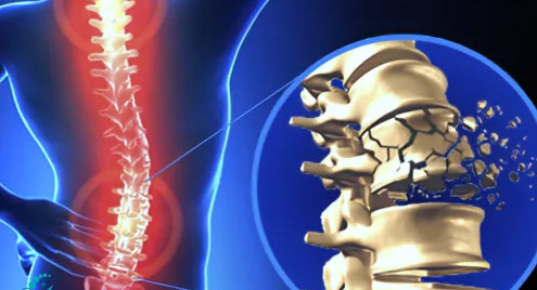 Stem Cell Therapy for Spinal Cord Injury