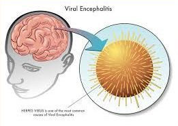 Stem Cell Therapy for Encephalitis Recovery