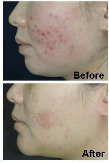 Acne & Acne Scar Care