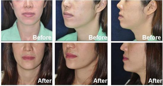 Chin-augmentation-1.jpg