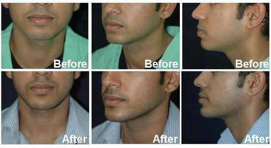 Chin-augmentation-2.jpg