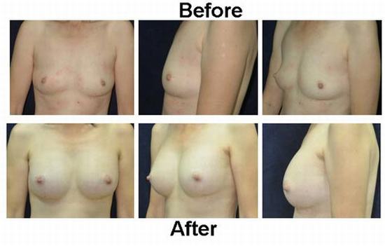 Breast-augmentation-2.jpg