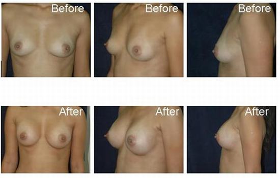 Breast-augmentation-3.jpg